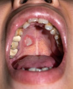 mouth sore, possible oral cancer symptoms