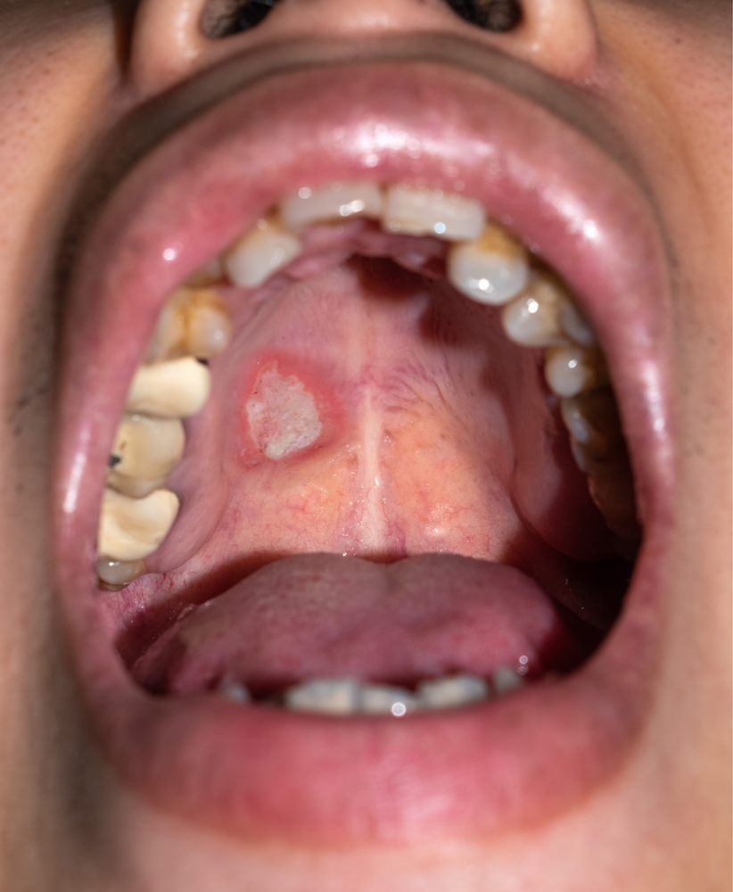Early Signs of Oral Cancer