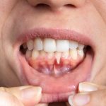 gum recession