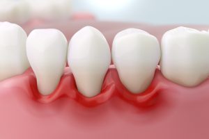 gum disease and inflammation