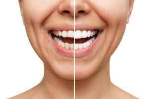 veneers before and after