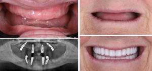dental implants before and after