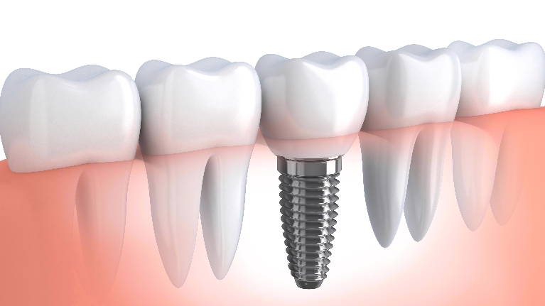 Single dental implant with adjacent natural teeth, illustrating tooth replacement options at Robles Family Dental.