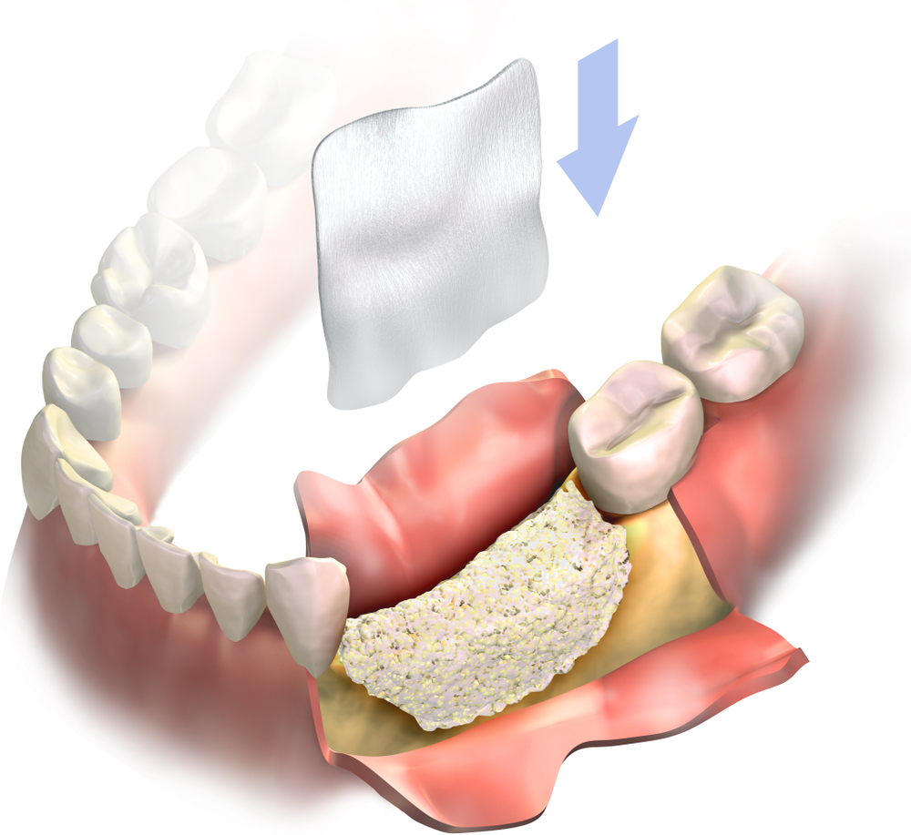 bone grafting procedure