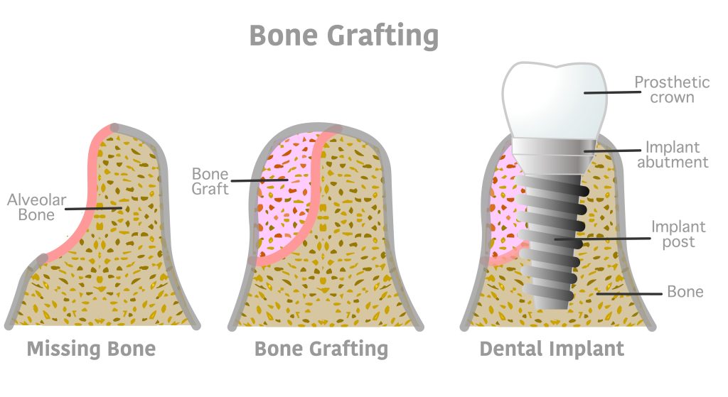 bone grafting for dental implants