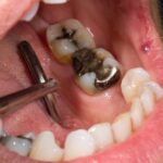 cracked silver amalgam fillings