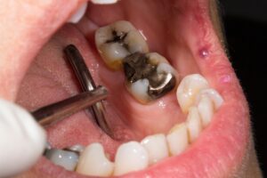 cracked silver amalgam fillings