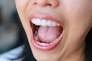woman's mouth open showing tooth decay