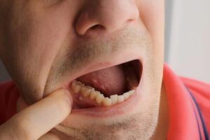 Man showing signs of dental distress by pointing at his gum, illustrating symptoms of a fractured tooth or dental abscess.