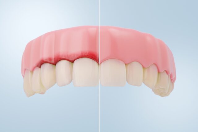 gum recession, unhealthy gums